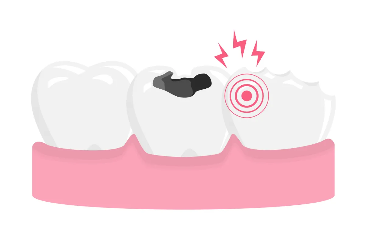 Cavity Filling Treatment Cost Sinhagad Road Pune