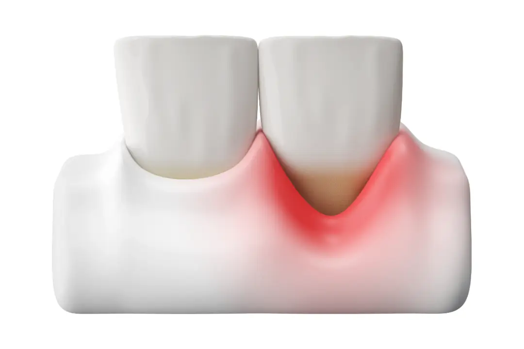 Gum Disease Cost Sinhagad Road Pune