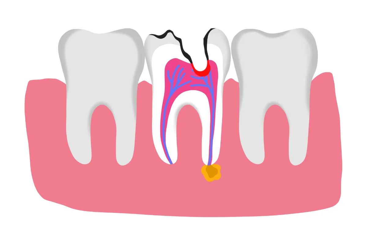 Root Canal Treatment Cost Sinhagad Road Pune