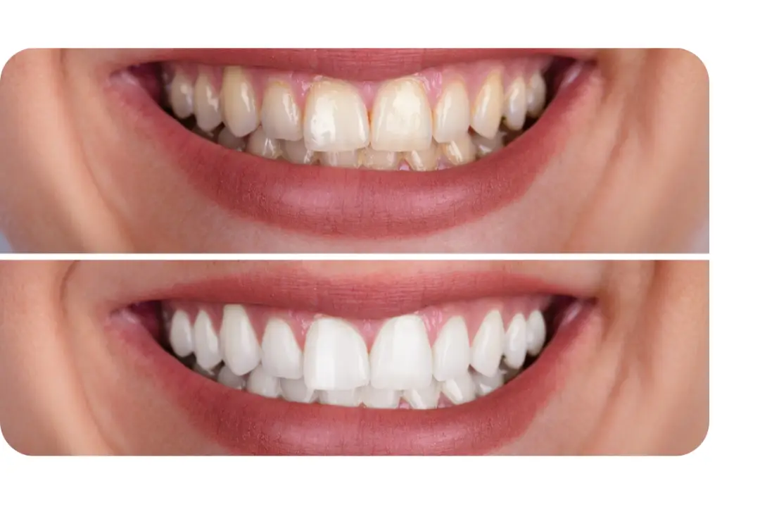 Teeth Whitening Treatment Cost Sinhagad Road Pune